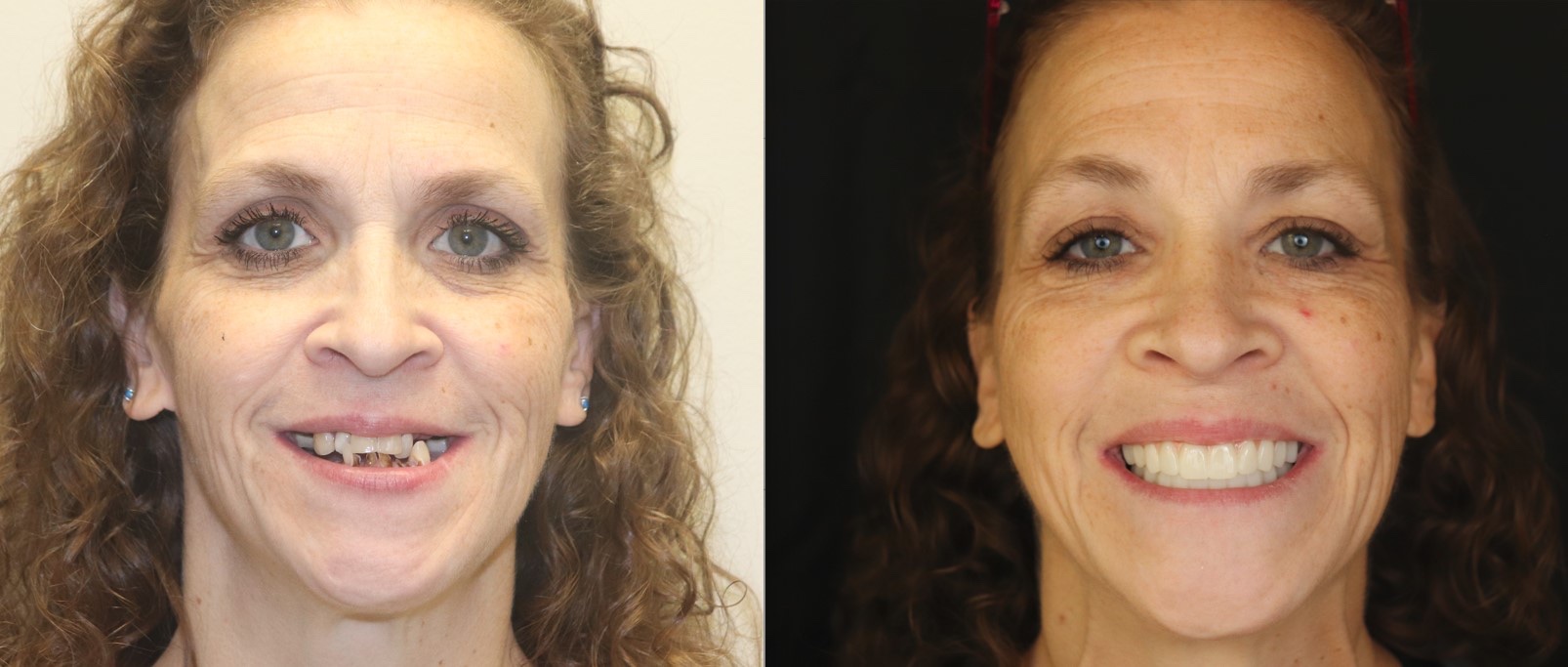 Another beautiful lady excited to get her smile back!