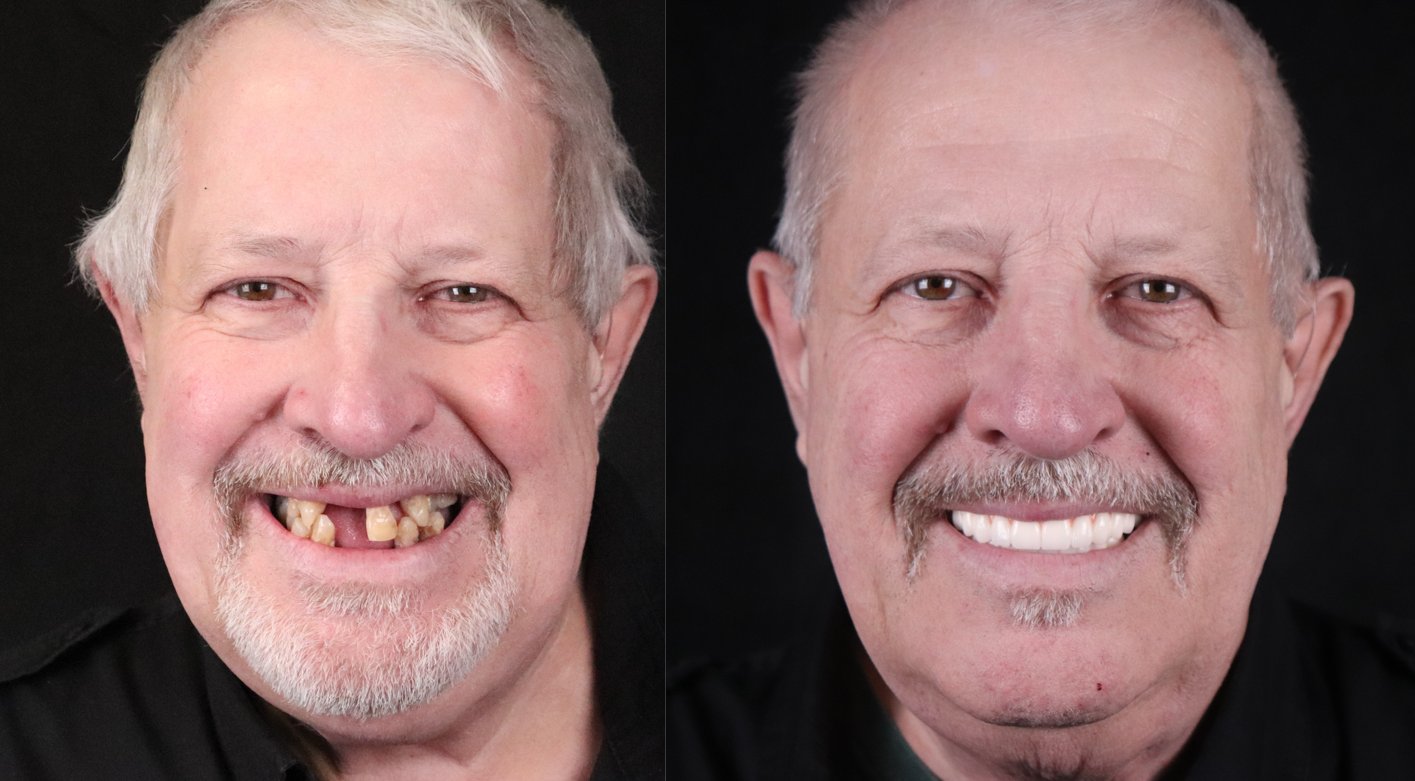 William just wanted to smile without having to think about it. Eating was a chore and he had to be picky about what he ate. Not Anymore!